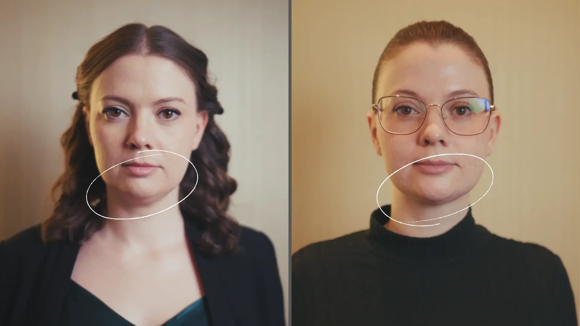 Toka zsírleszívás előtte-utána 1